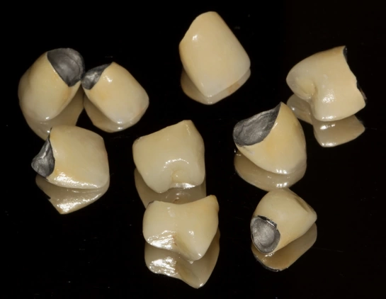 Протезирование зубов из металлокерамики
