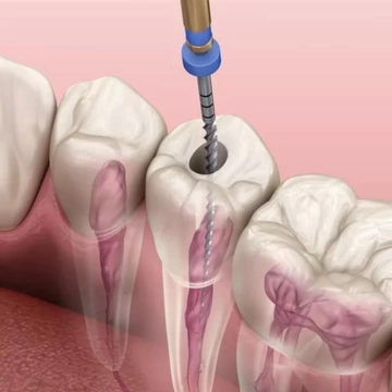 Лечение корней зубов