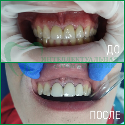 протезирование зубов фото 3
