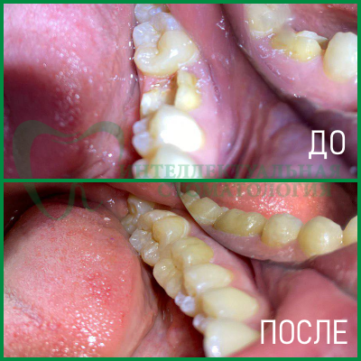 протезирование зубов фото 2