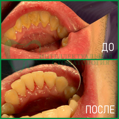 ультразвуковая чистка зубов фото 2