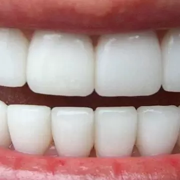 Протезирование зубов из безметалловой керамики