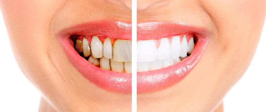 Шишка на десне: что это такое, причины и лечение — Экспертные статьи на сайте стоматологии АРТ