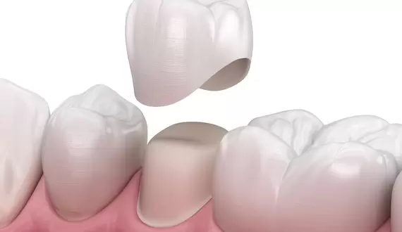 Фиксация коронок на зуб: как правильно осуществляется