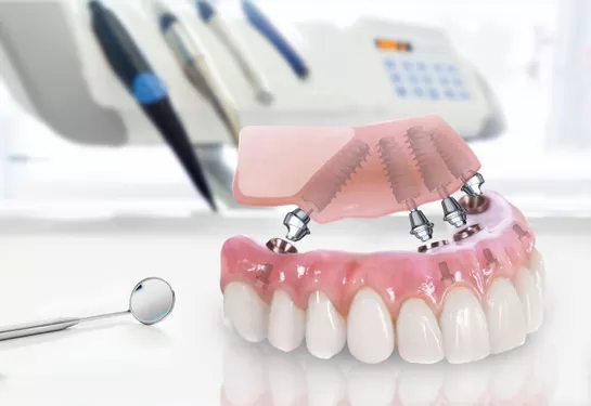 Имплантация зубов в Минске, цены на установку импланта зубов под ключ