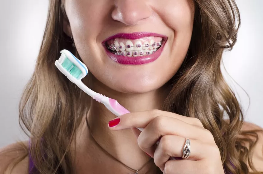 Следует ли пользоваться особой зубной пастой, когда установлены брекеты