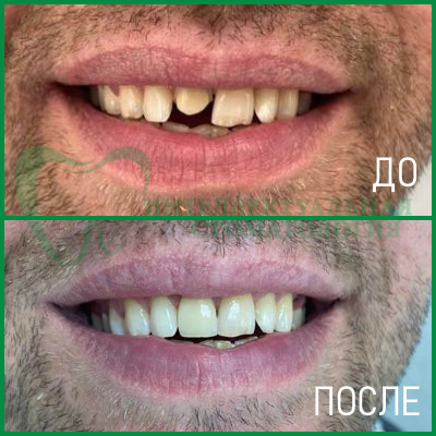 протезирование зубов фото 5