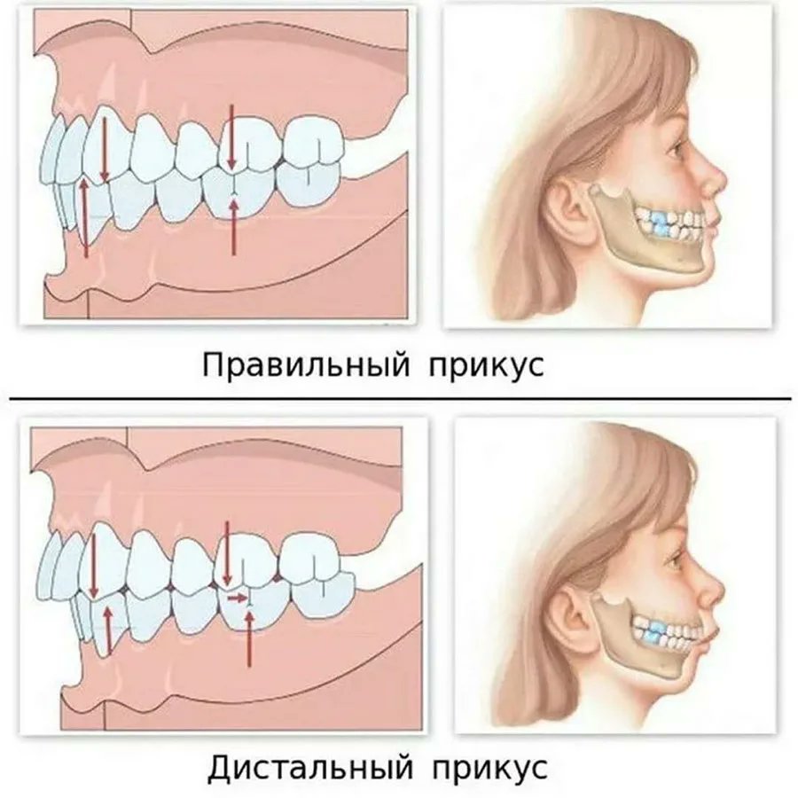 Нарушение прикуса: что такое, причины, виды