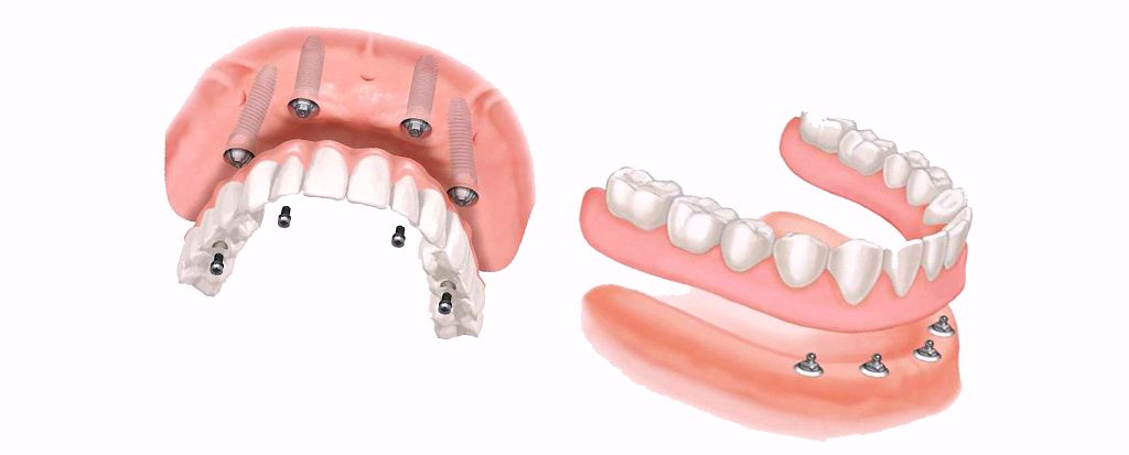 Какой протез выбрать. All on 4 имплантация под ключ цена. Зубные протезы виды классификация и цена.