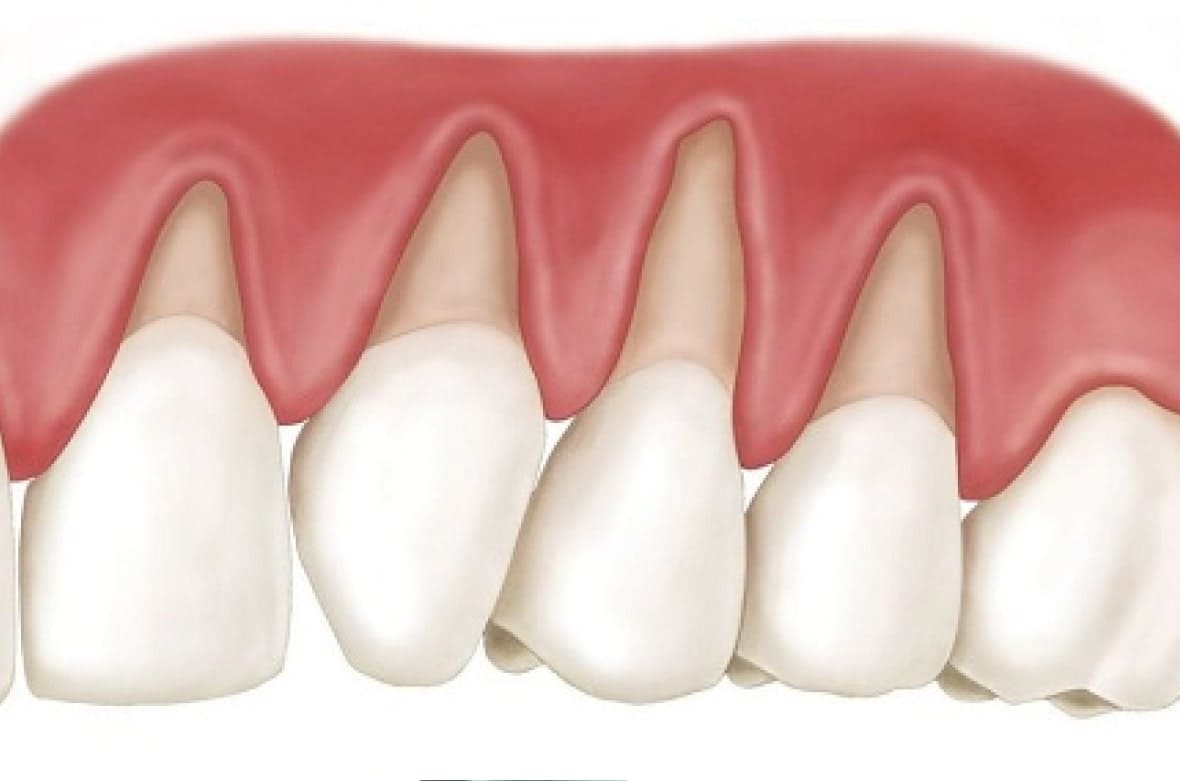 Оголение десен: симптомы, лечение, профилактика