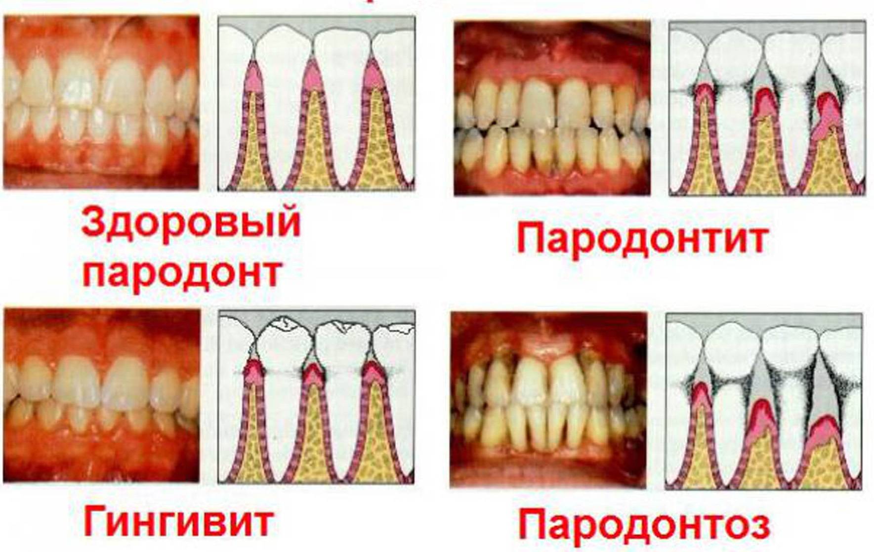 Пародонтоз: описание, лечение и профилактика - Что такое пародонтоз