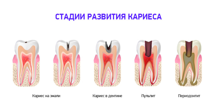 Откуда берется кариес зубов