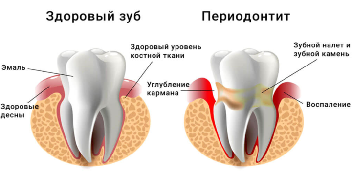 Периодонтит: причины, симптомы и лечение