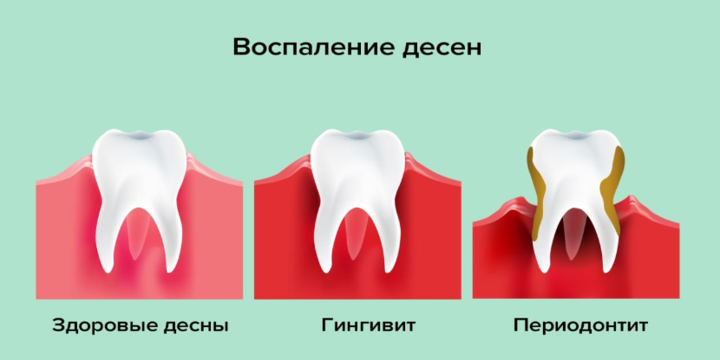 Воспаление десен - причины и симптомы гингивита.