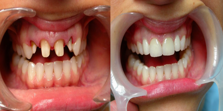 Нет зубов: какой протез лучше поставить? | Статьи