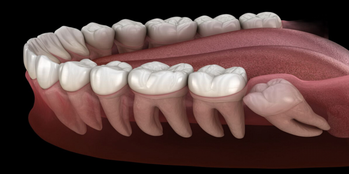 Зубы мудрости: удалить или вылечить?