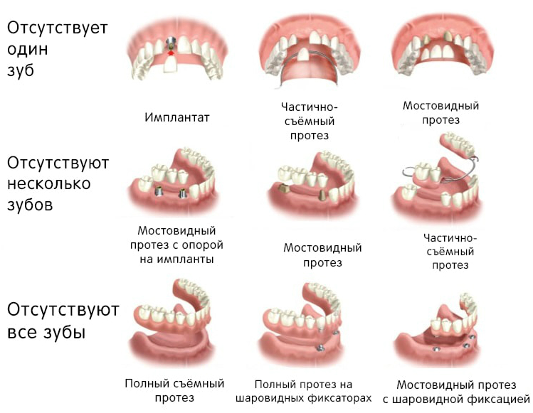 Имплантация зубов в Белоруссии