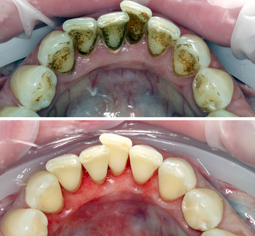 Снятие зубного камня ультразвуком – цены, методика, отзывы | Гигиена и Отбеливание