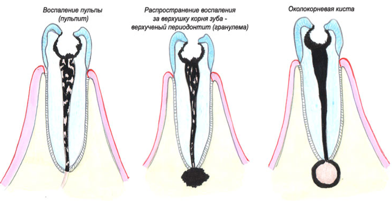 Периодонтит и пульпит разница. Гранулема верхушки корня.