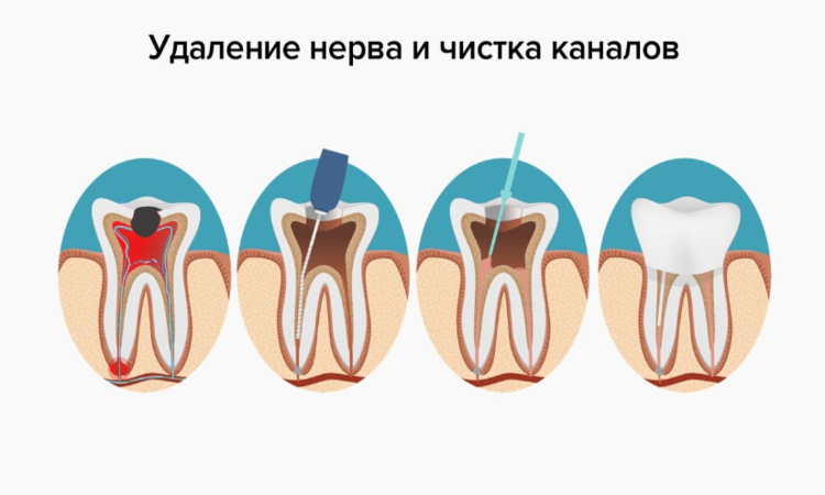 Удаление нерва зуба: отвечаем на самые частые вопросы