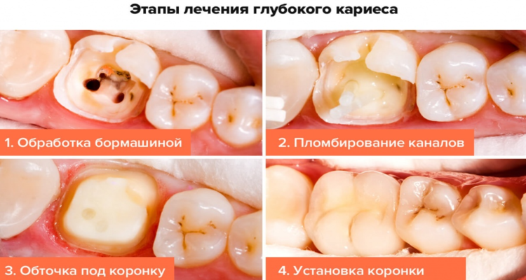 Если зуба почти нет, можно ли его восстановить